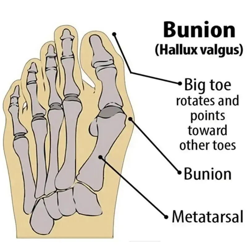 BunionCare® Orthopedic Bunion Corrector