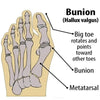BunionCare® Orthopedic Bunion Corrector