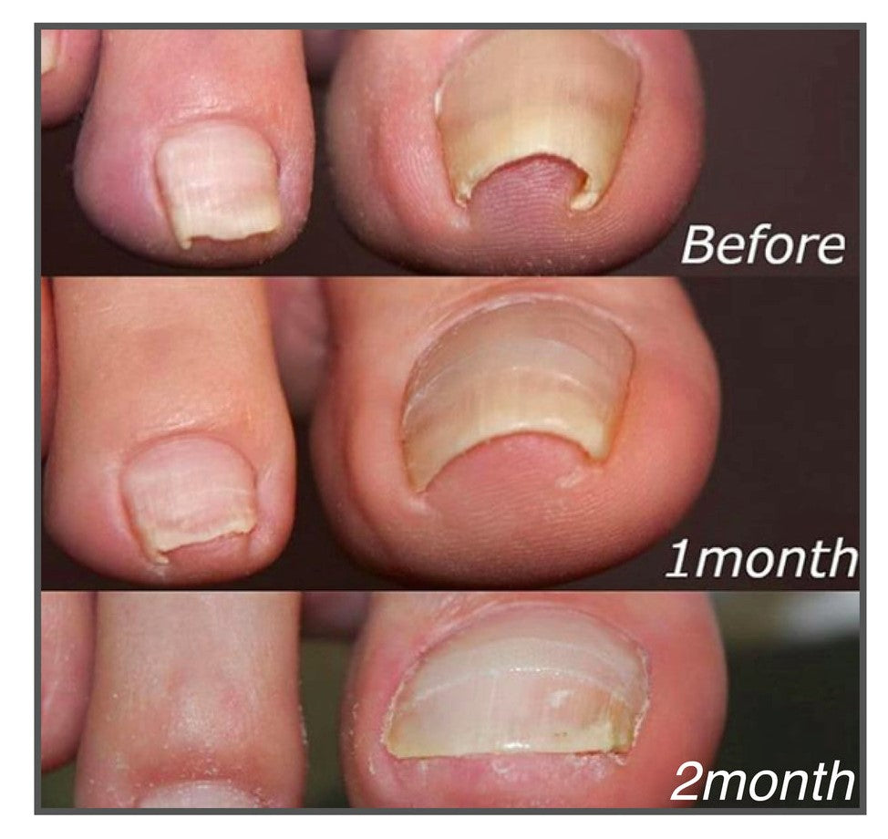 1+1 FREE | Easy Patches™ - Say Goodbye to Nail Pain!
