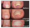 1+1 FREE | Easy Patches™ - Say Goodbye to Nail Pain!